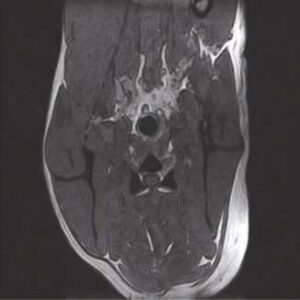 T1 3D FLASH Transverse Post Contrast
