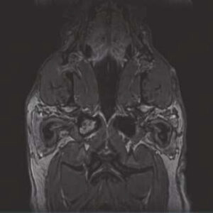 T1 3D FLASH Dorsal Post Contrast